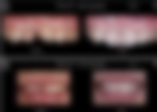 口腔种植的优缺点分析及适应人群