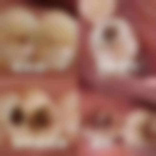 临床实例分享:郑州乐帆口腔门诊部杨金锋
