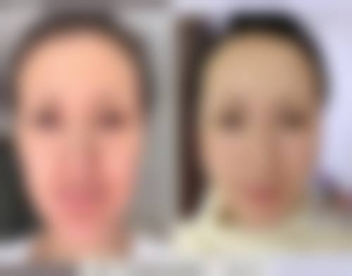 临床实例分享杭州新友好医疗美容门诊部袁利森